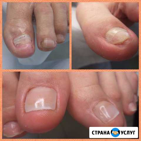 Аппаратный педикюр и подология Вологда - изображение 1