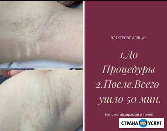 Электроэпиляция Махачкала