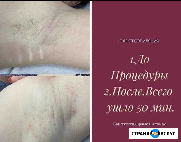 Электроэпиляция Махачкала - изображение 1
