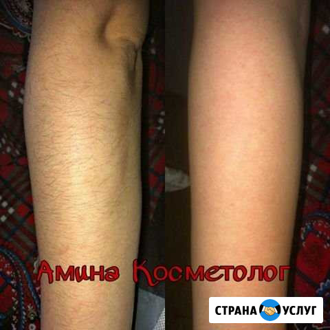 Шугаринг Хасавюрт - изображение 1