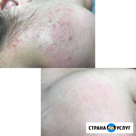 Холодная плазма Сургут - изображение 1