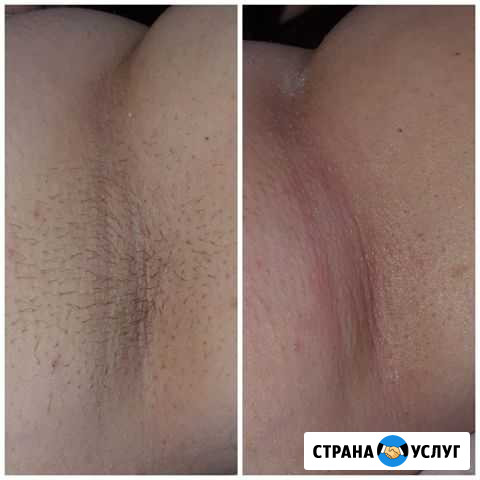 Восковая депиляция Муравленко - изображение 1
