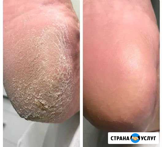 Обучение Карбамидный педикюр (бесплатное) Новосибирск - изображение 1