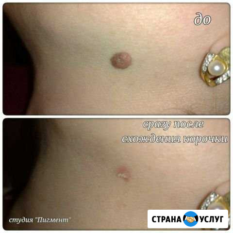Удaлить рoдинки, папиллoмы, бoродавки Домодедово - изображение 1