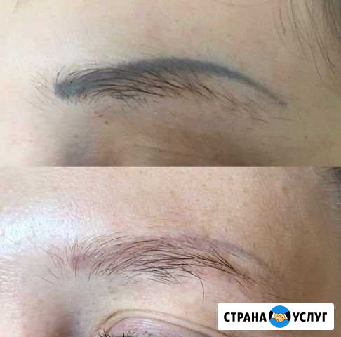 Удаление татуажа и татуировок Новосибирск - изображение 1