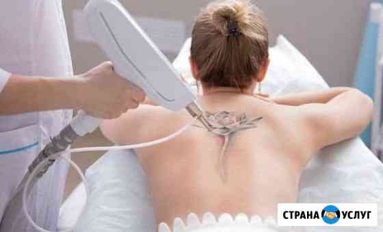 Удаление тату и татуажа Краснодар