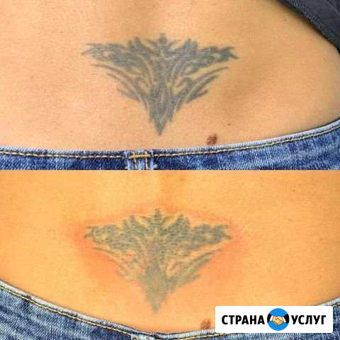 Удаление татуажа и татуировок лазером без шрамов и Махачкала - изображение 1