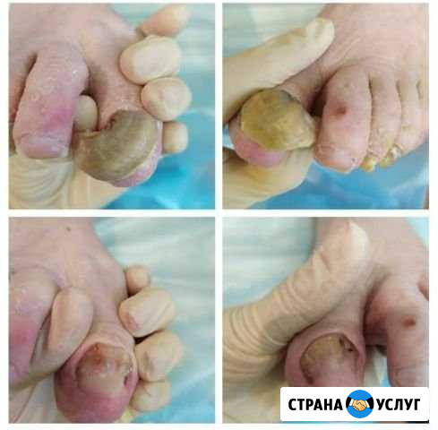 Аппаратный педикюр Вологда - изображение 1