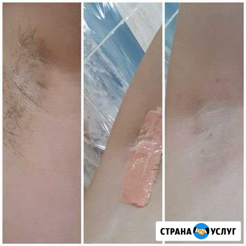 Шугаринг Чебоксары - изображение 1