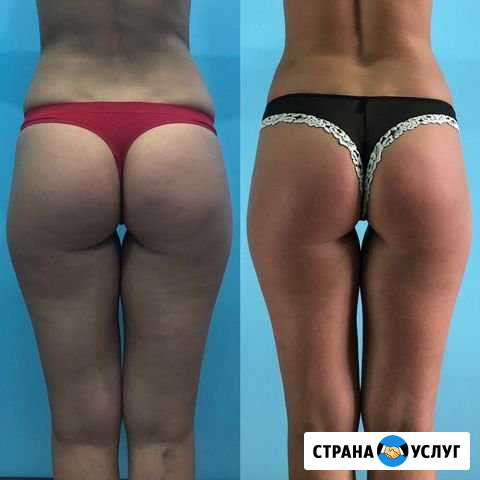 Антицеллюлитный массаж Новокузнецк - изображение 1