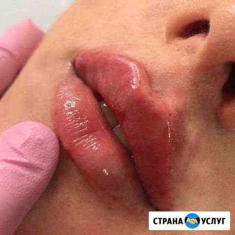 Контурная пластика Королев