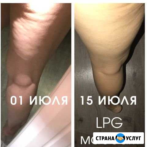 LPG массаж Симферополь - изображение 1