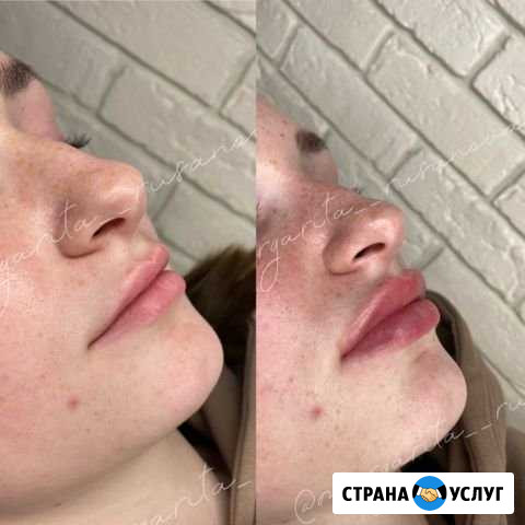 Увлажнение губ Коммунарка - изображение 1