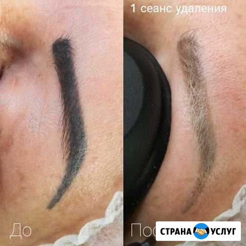 Удаление тату Нижний Новгород - изображение 1