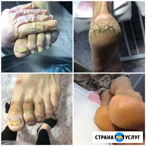 Аппаратный педикюр Староминская - изображение 1