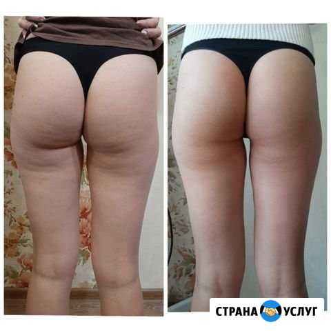 Антицеллюлитный массаж Нижний Новгород - изображение 1