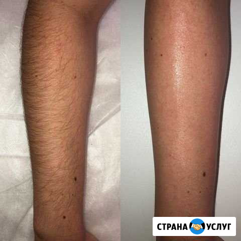 Шугаринг Орёл - изображение 1