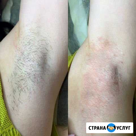 Электроэпиляция в Обнинске. Удаление волос навсегд Обнинск - изображение 1