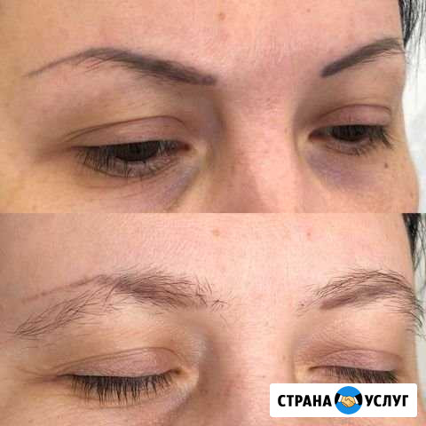 Лазерное удаление Челябинск - изображение 1