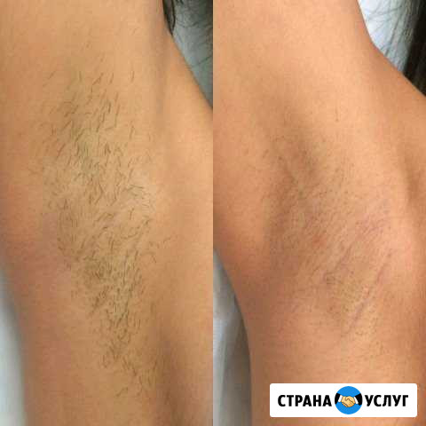 Шугаринг муж.и жен.Сахар,воск,пленочный воск Пенза - изображение 1