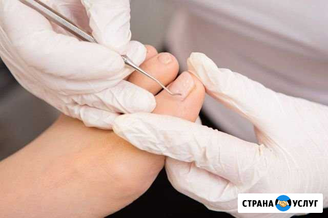 Медицинский педикюр Мурманск - изображение 1