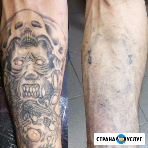 Удаление татуировок и татуажа Саратов - изображение 1