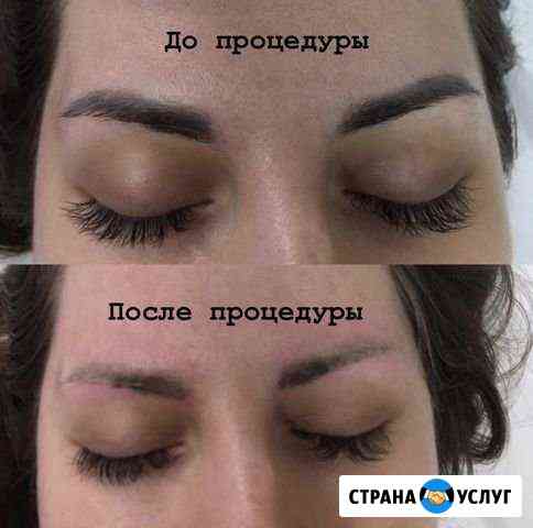 Удаление татуажа и татуировок Люберцы