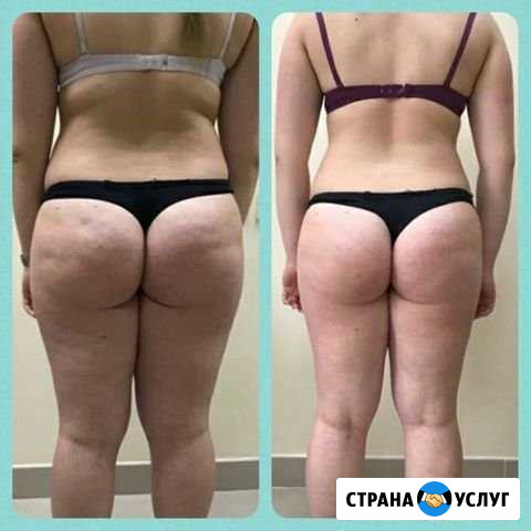 Аппаратный массаж Нижний Новгород - изображение 1