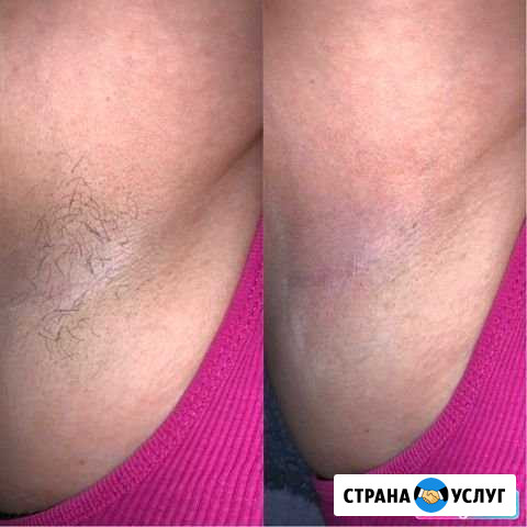 Шугаринг Нижний Тагил - изображение 1