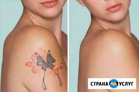 Лазерное удаление тату и татуажа Екатеринбург