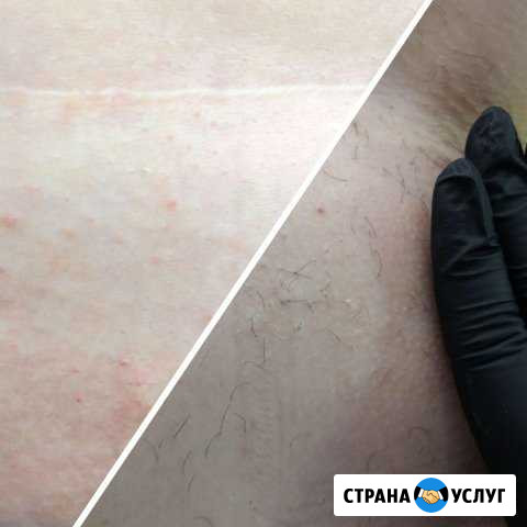 Депиляция Майкоп - изображение 1