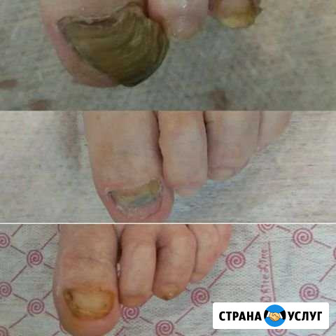 Услуги мед.педикюра(грибок,мозоли,вросш.ноготь) во Владикавказ - изображение 1