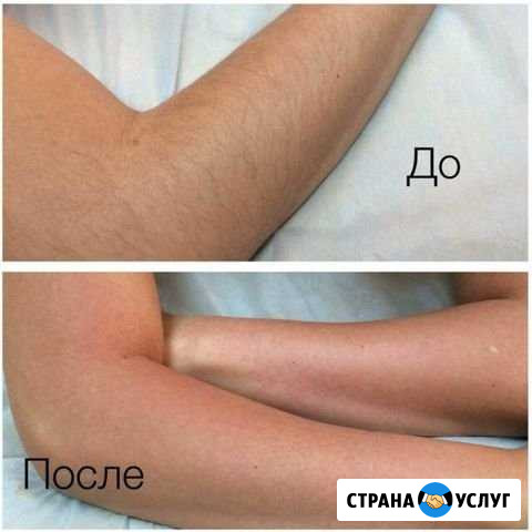 Депиляция Симферополь - изображение 1