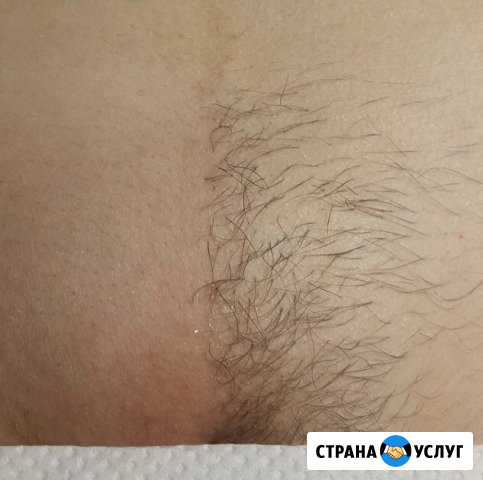 Эпиляция Шугаринг Видное - изображение 1