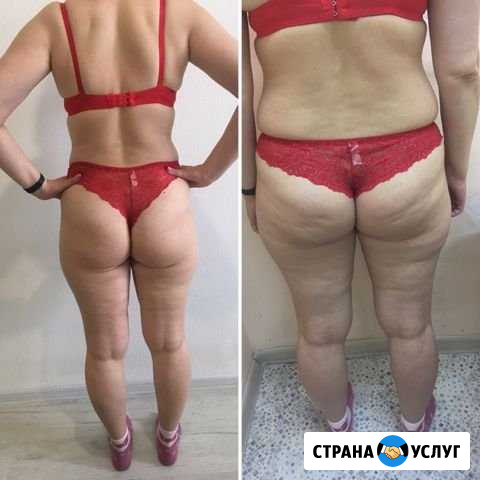 Антицеллюлитный массаж Петрозаводск - изображение 1