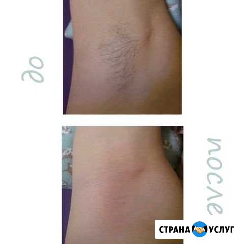 Шугаринг Нижнекамск - изображение 1
