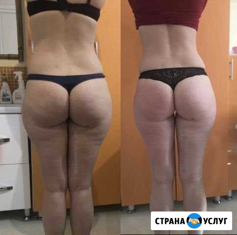 Антицеллюлитный массаж, коррекция фигуры Воронеж - изображение 1