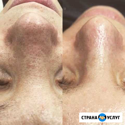 Чистка лица Мурманск - изображение 1