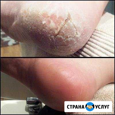 Качественный педикюр, пяточки как у младенца Ставрополь - изображение 1