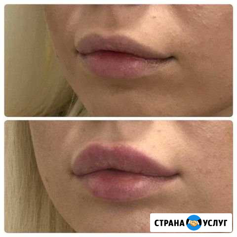 Красивые губы Нижний Новгород - изображение 1