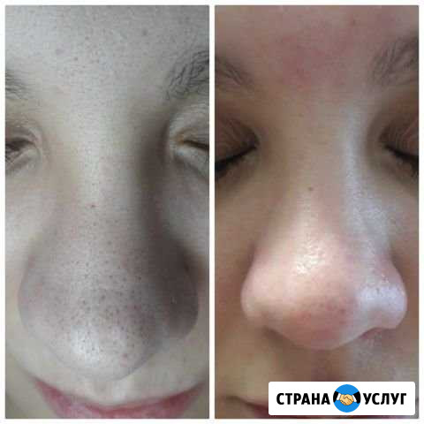 Чистка лица. Косметолог Иркутск - изображение 1