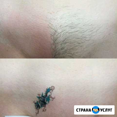 Шугаринг Воск Электроэпиляция Ставрополь - изображение 1