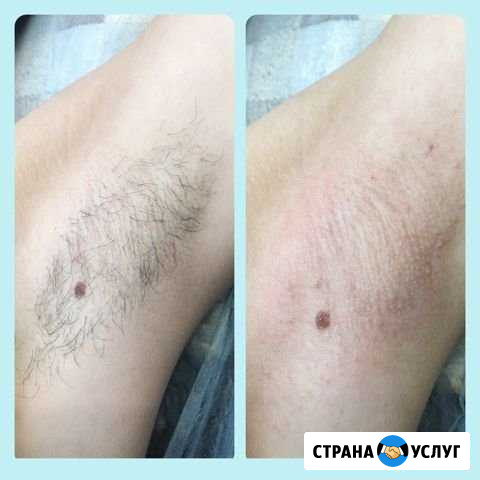 Шугаринг, Ваксинг Нижний Новгород - изображение 1