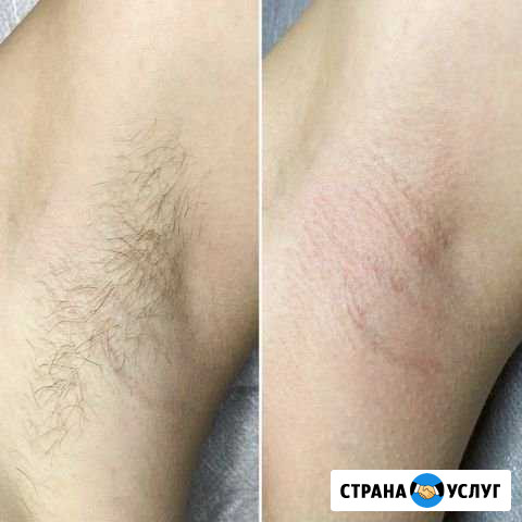 Депиляция воском Королев - изображение 1