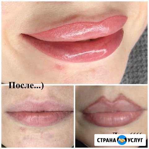 Удаление татуировок Махачкала - изображение 1