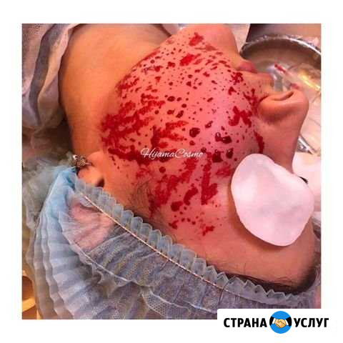 Капилляротерапия и Косметология Хасавюрт - изображение 1