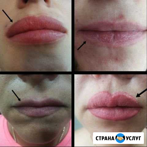 Лазерное удаление не качественного татуажа.Ремувер Брянск - изображение 1
