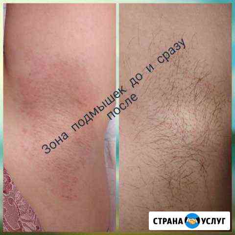 Электроэпиляция Шахты