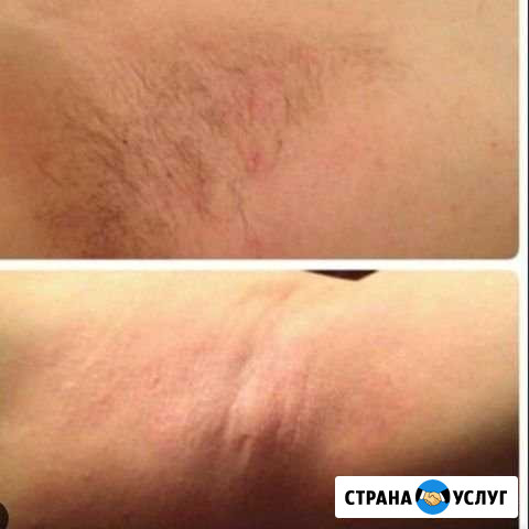Эпиляция на дому и с выездом Семендер - изображение 1