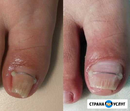 Педикюр с решением проблем Йошкар-Ола - изображение 1